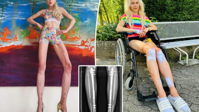 A la quête de l&rsquo;idéal de beauté: Une mannequin se fait allonger les jambes de 14 cm  ‎