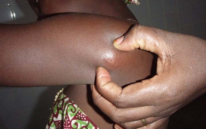 Ulcère de Buruli:  Une campagne gratuite pour soigner les plaies chroniques